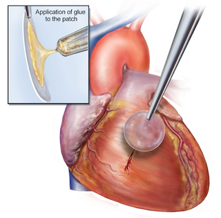 Illustration for article titled This worm-inspired glue can mend broken hearts